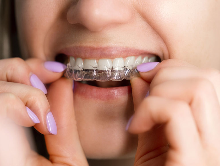 Benefits of Invisalign