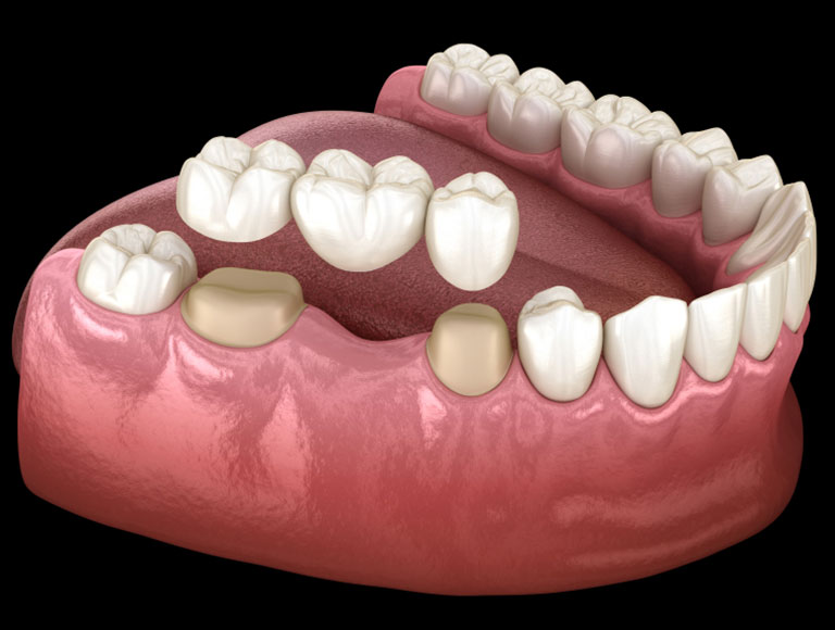 Dental Bridges