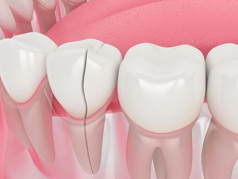 Cracked Tooth Repair