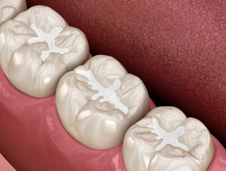 What are Dental Fillings?