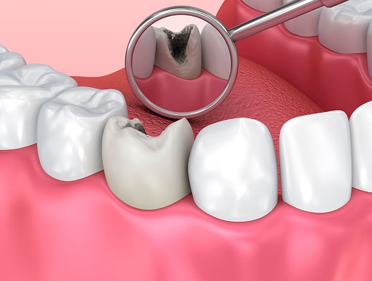 Infected Tooth Extractions