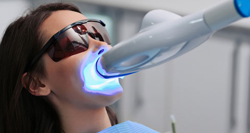 Home Teeth Whitening