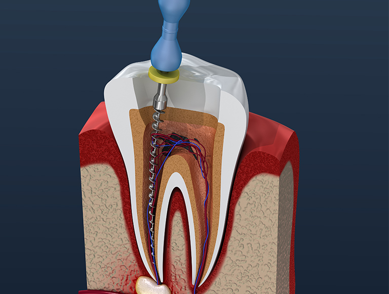 Root Canal