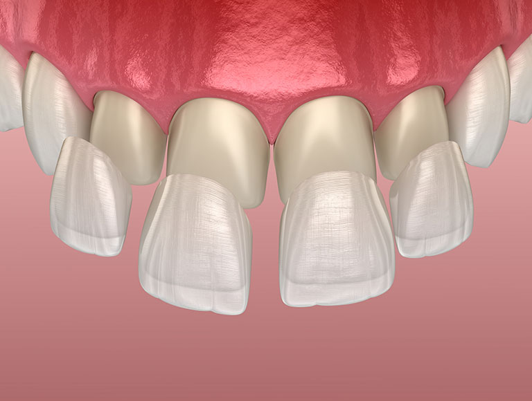 Porcelain Veneers