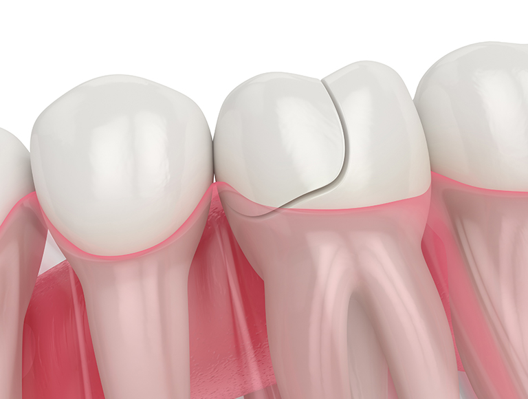 Cracked Tooth Repair