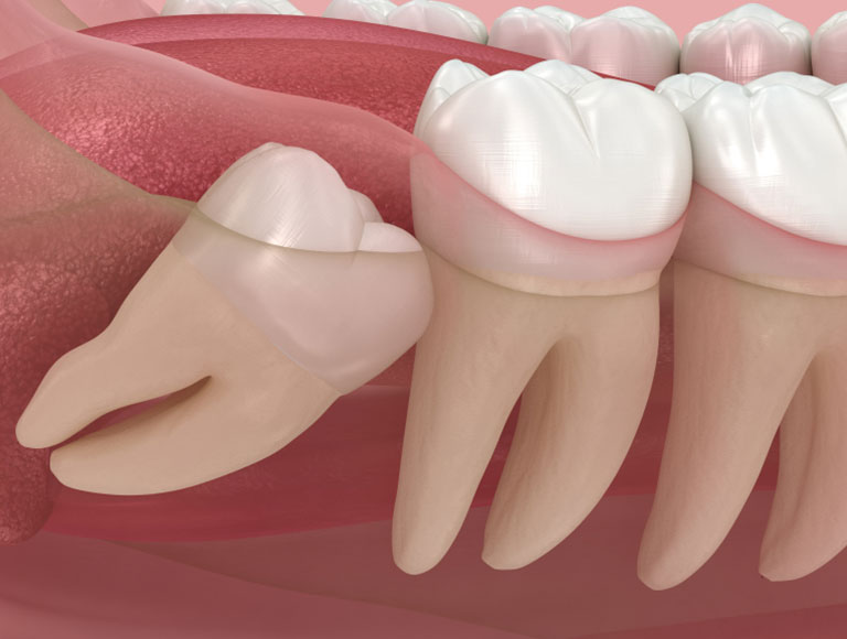 Wisdom Teeth Removal